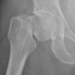 xrayhipfracture-article