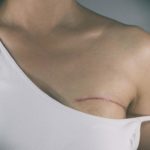 woman-with-breast-cancer-scar