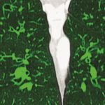 1068733_cystic-fibrosis-ct-scan-lungs-15