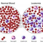 Leukemia