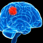 August3_2015_iStock_000018235224_BrainCancer_NeuroblastomaWeapon_GNH2795153124