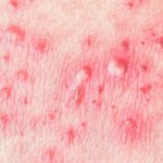 shingles-rash-varicella-zoster