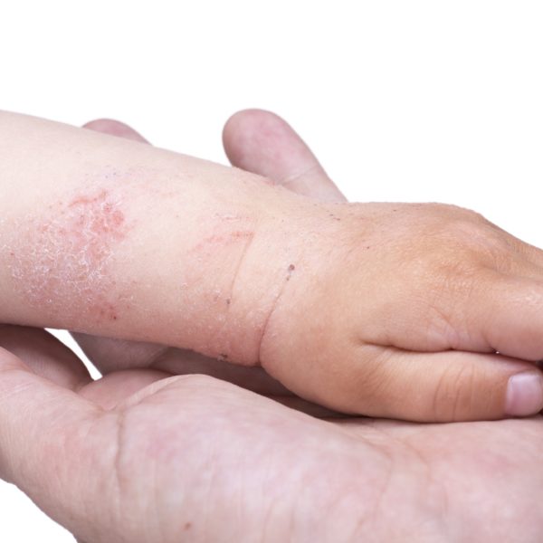 L’eczema potrebbe essere trattata con una proteina della gravidanza eczema