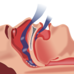 sleepapnea