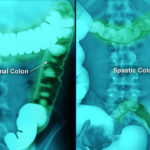webmd_rm_photo_of_colon_blockage