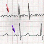 Afib_ecg