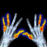 rheumatoid-arthritis-early-symptoms-signs-s13-symmetric