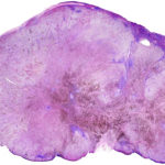 1280px-Lymph_node_with_metastatic_melanoma_-_by_Gabriel_Caponetti,_MD