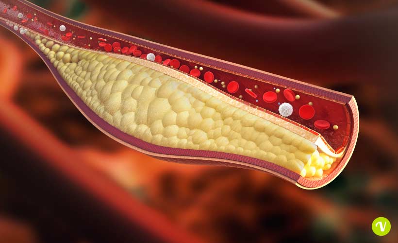 Evolocumab, il primo anti colesterolo di nuova generazione colesterolo,Evolocumab