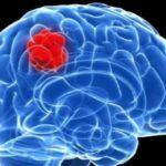 braintumours