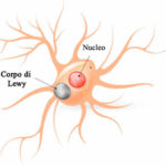 corpi-di-lewy