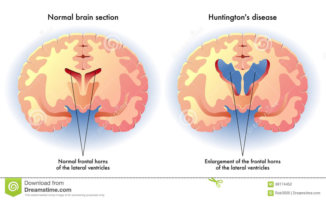 Un farmaco anti-tumorale può trattare la malattia di Huntington malattia di Huntington