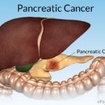 Pancreatic-Cancer