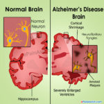 alzheimer-disease-brain