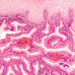 metaplasia-intestinale-barrett