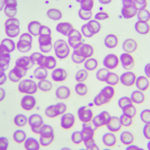 talassemia_35051