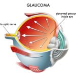 Glaucoma-diagram