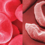 anemia-falciforme