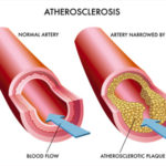 cause-aterosclerosi-cura-calcificazioni-aorta