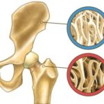 densità-ossea-500x375
