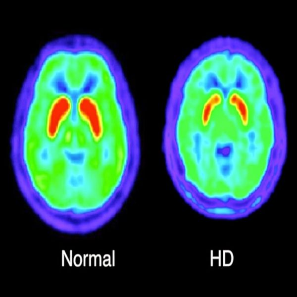 Decodificata la struttura molecolare tridimensionale della huntingtina Huntington
