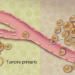 metastasi
