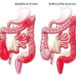 5251_53_1339662387_crohn_retro