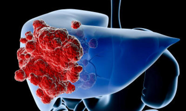 Cancro epatico correlato all’alcol può avere una prognosi peggiore rispetto ad altre forme cancro epatico