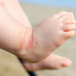 bambino-eczema-piedi