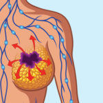 breast-cancer-s3-causes