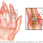 ds00020_im02689_r7_rheumatoidarthritisthu_jpg