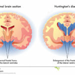 huntington-s-disease-medical-illustration-symptoms-brain-68174452