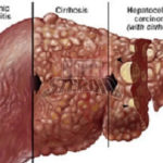 liver-diseases