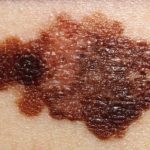 melanoma
