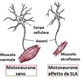 Risultati immagini per foto malattia sla