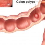 polipi-intestinali