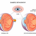 retinopatia-diabetica-20016314
