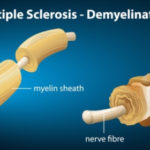 sclerosi-multipla