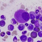 1355126275523_leucemia