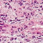 260px-Primary_biliary_cirrhosis_intermed_mag_much_cropping