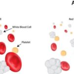 Anemia