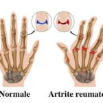 Artrite-reumatoide