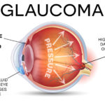 GLAUCOMA-diagram