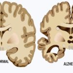 alzheimer-causes-FI-800x420
