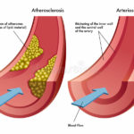 aterosclerosi-arteriosclerosi-31746909