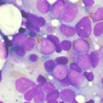 myeloidleuke
