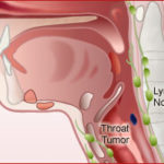 stage-1-head-neck-cancer
