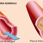 Aterosclerosi