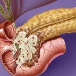 TUMORE-PANCREAS-COP