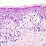 melanoma